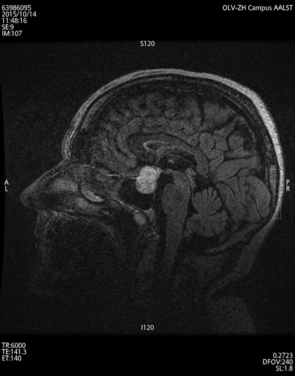 Hersenen: hypofysetumor