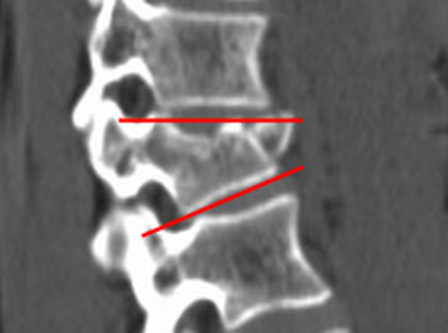 Vertebroplastie: Ernstige breuk van de
		                                        12de borstwervel