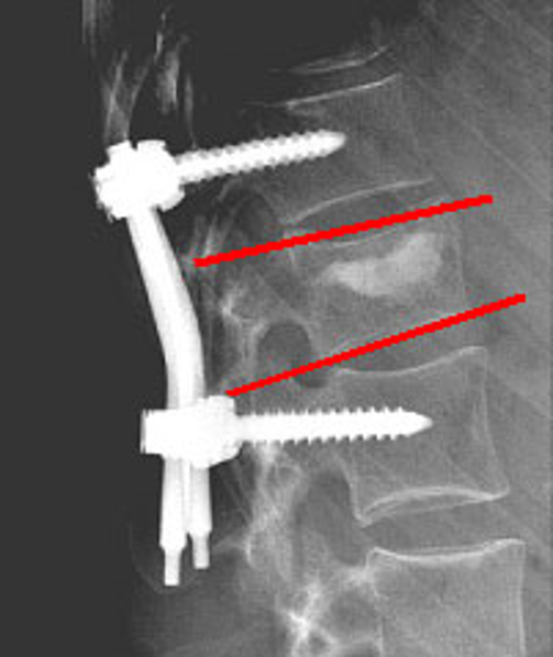 Vertebroplastie: Anatomisch
		                                        herstel van de wervel