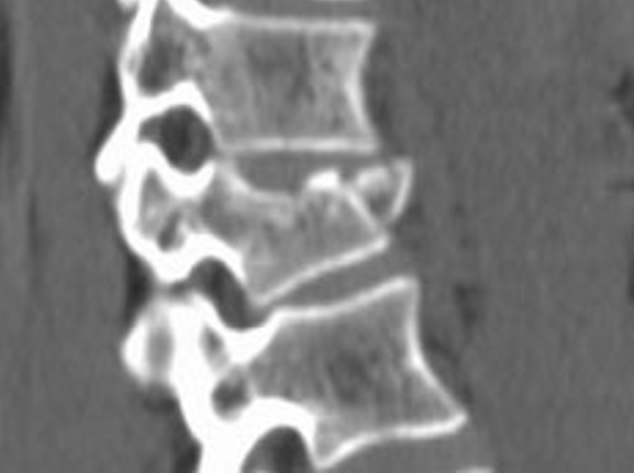 Fracture of 11th vertebra after a fall from a horse