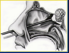 Hypofyse endoscopie