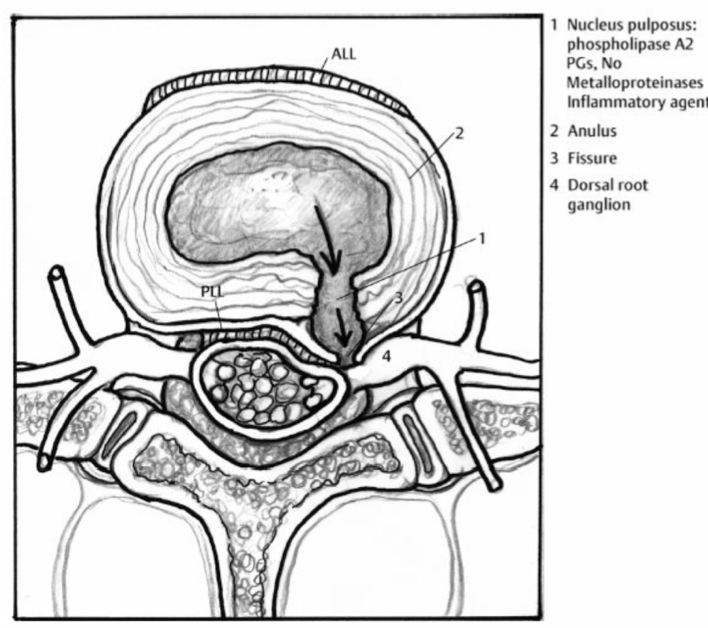 Rug: Lumbale discus hernia