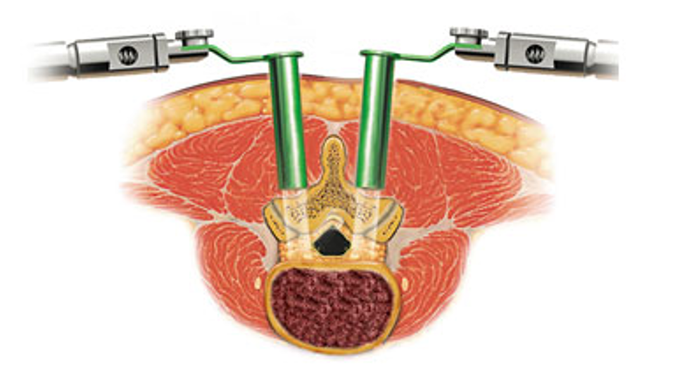 Opération du dos : aujourd'hui, mini-invasive et hâtant la guérison 